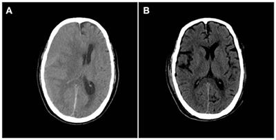 Chronic Subdural Hematoma Caused by Acute Myeloblastic Leukemia: A Case Report